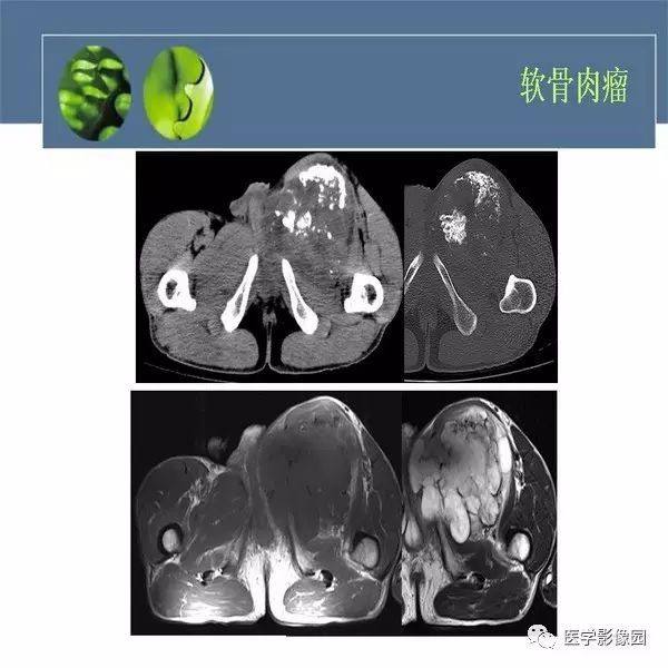 【病例】右侧髂骨甲状腺癌转移瘤1例CT及MR