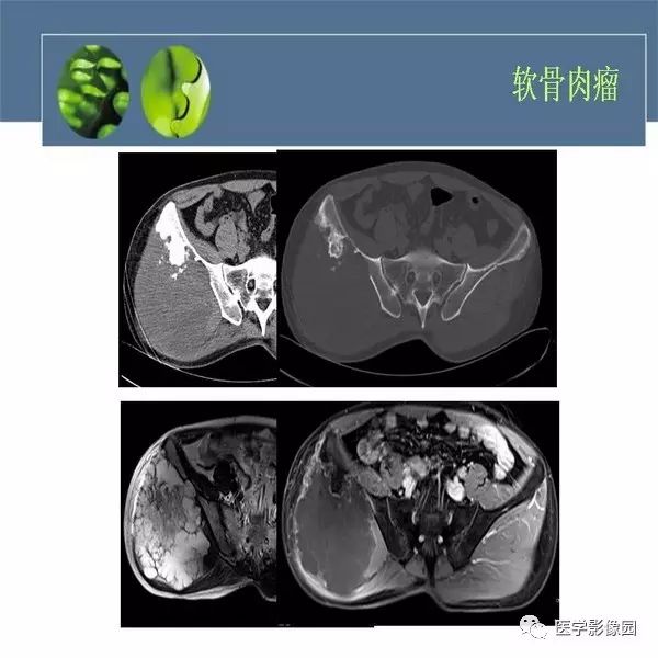 【病例】右侧髂骨甲状腺癌转移瘤1例CT及MR