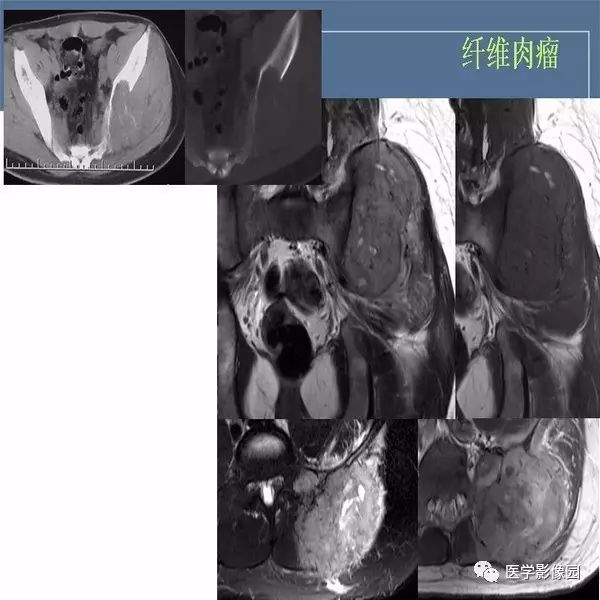 【病例】右侧髂骨甲状腺癌转移瘤1例CT及MR