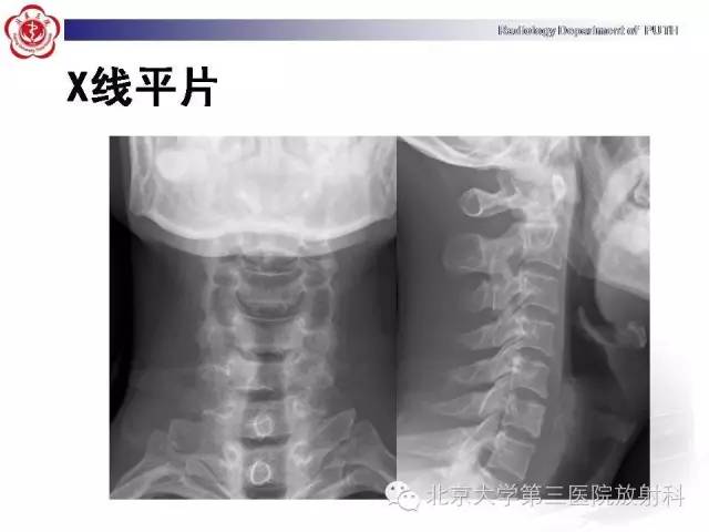 【病例】颈椎脊索瘤1例X线CT及MR