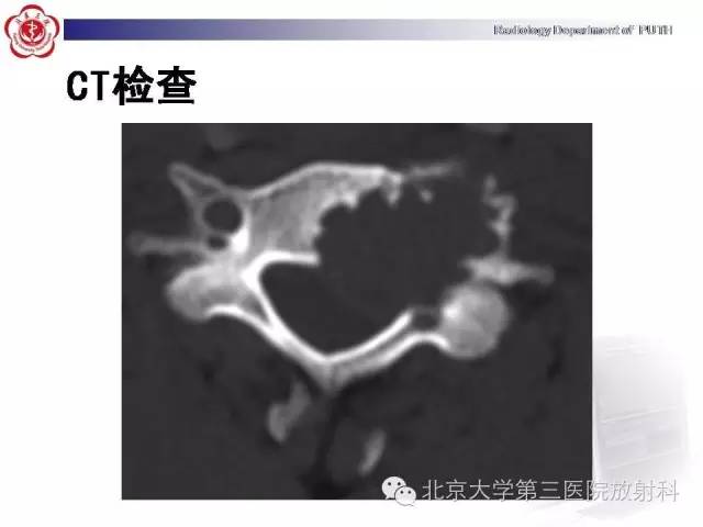 【病例】颈椎脊索瘤1例X线CT及MR