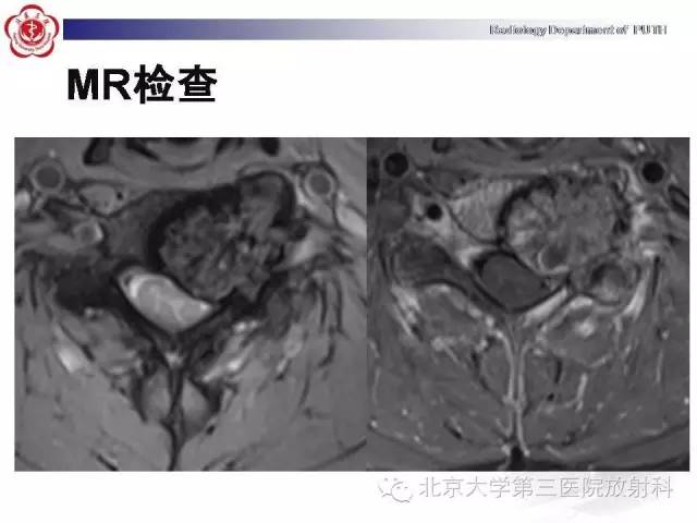【病例】颈椎脊索瘤1例X线CT及MR