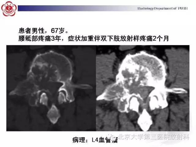 【病例】颈椎脊索瘤1例X线CT及MR