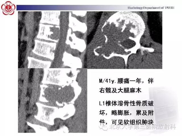 【病例】颈椎脊索瘤1例X线CT及MR