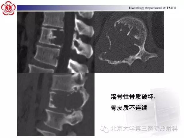 【病例】颈椎脊索瘤1例X线CT及MR