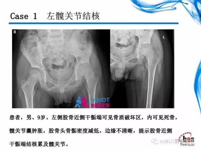 【PPT】四肢关节结核影像诊断与鉴别