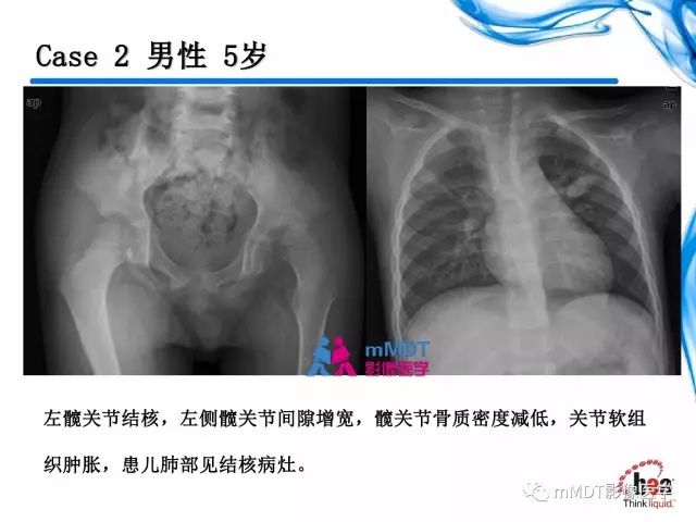 【PPT】四肢关节结核影像诊断与鉴别