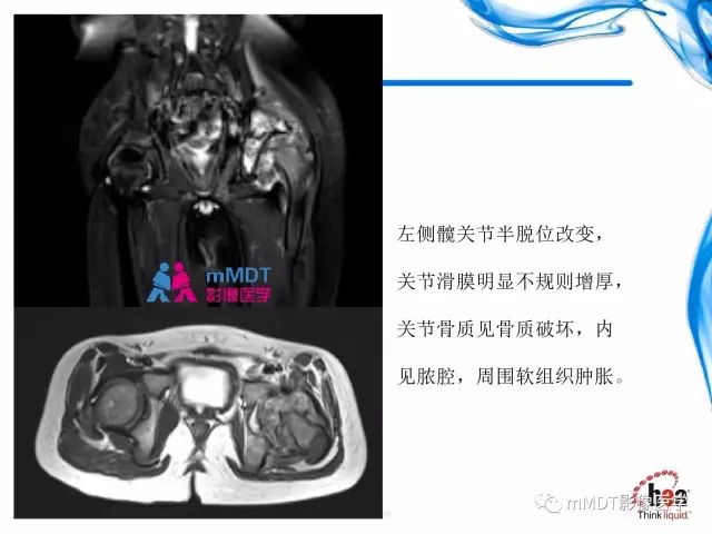 【PPT】四肢关节结核影像诊断与鉴别
