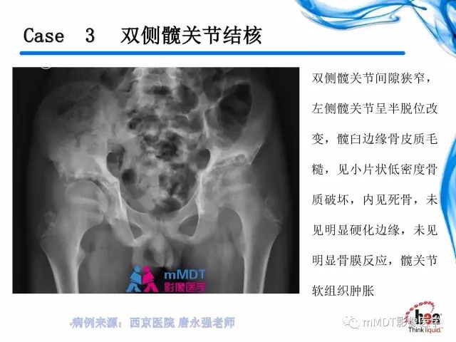 【PPT】四肢关节结核影像诊断与鉴别