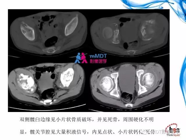 【PPT】四肢关节结核影像诊断与鉴别
