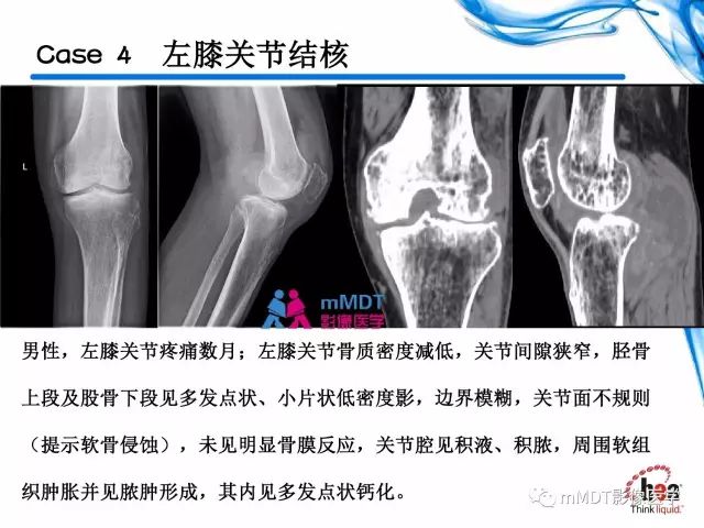 【PPT】四肢关节结核影像诊断与鉴别