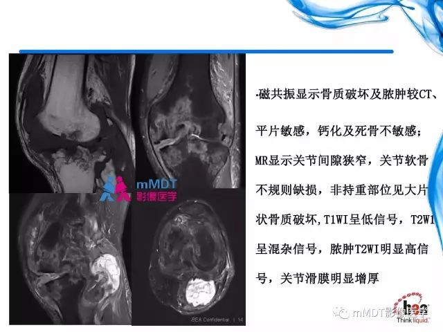 【PPT】四肢关节结核影像诊断与鉴别