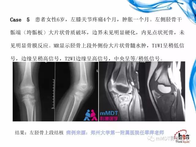 【PPT】四肢关节结核影像诊断与鉴别