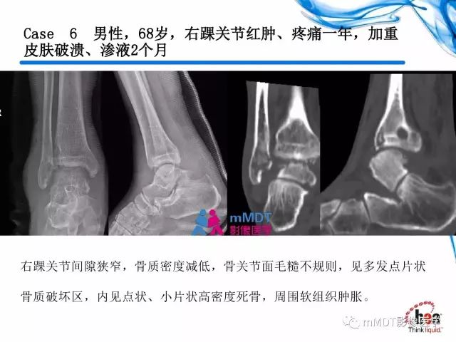 【PPT】四肢关节结核影像诊断与鉴别