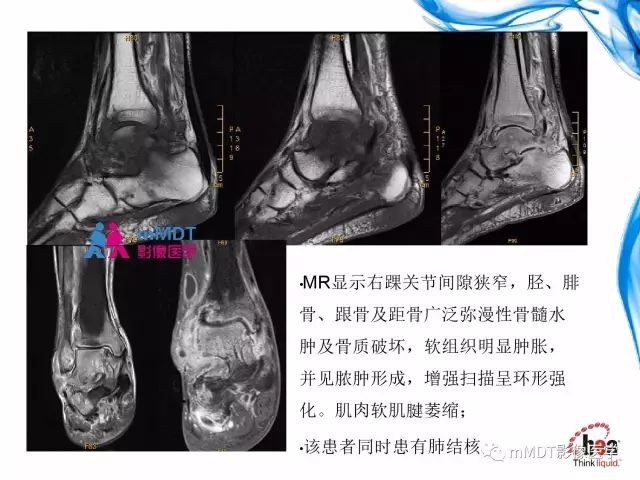 【PPT】四肢关节结核影像诊断与鉴别