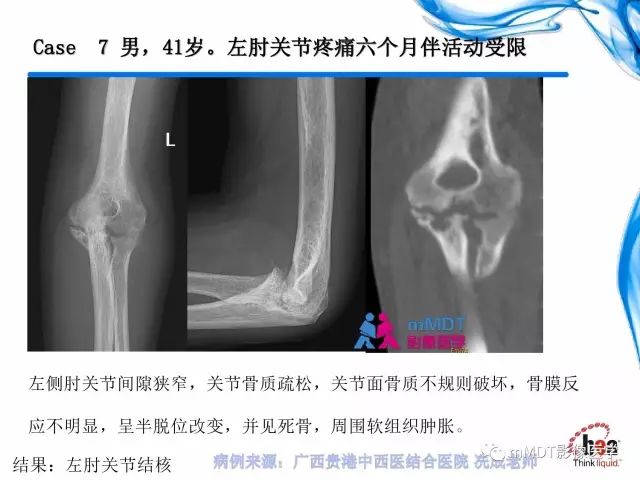 【PPT】四肢关节结核影像诊断与鉴别