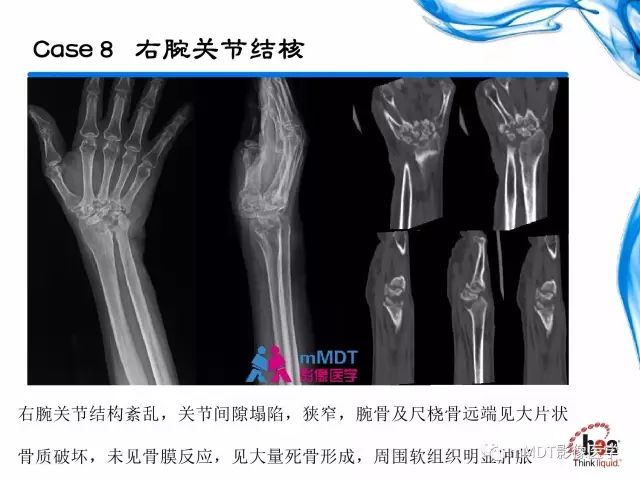 【PPT】四肢关节结核影像诊断与鉴别