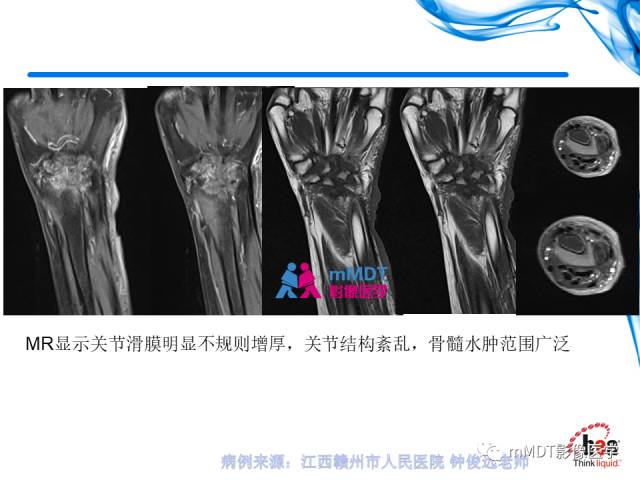 【PPT】四肢关节结核影像诊断与鉴别
