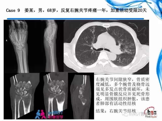 【PPT】四肢关节结核影像诊断与鉴别