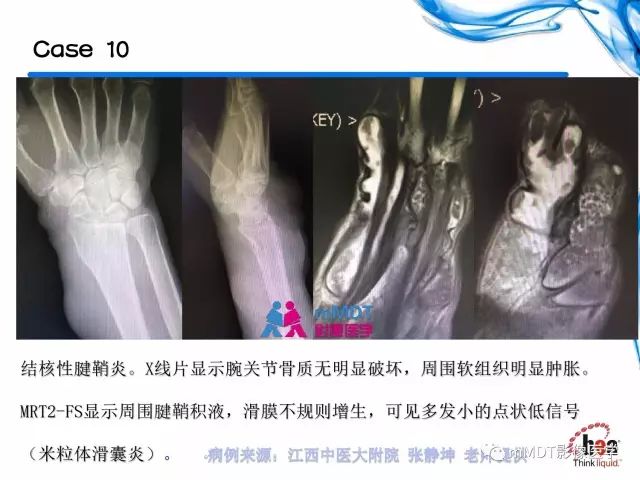 【PPT】四肢关节结核影像诊断与鉴别