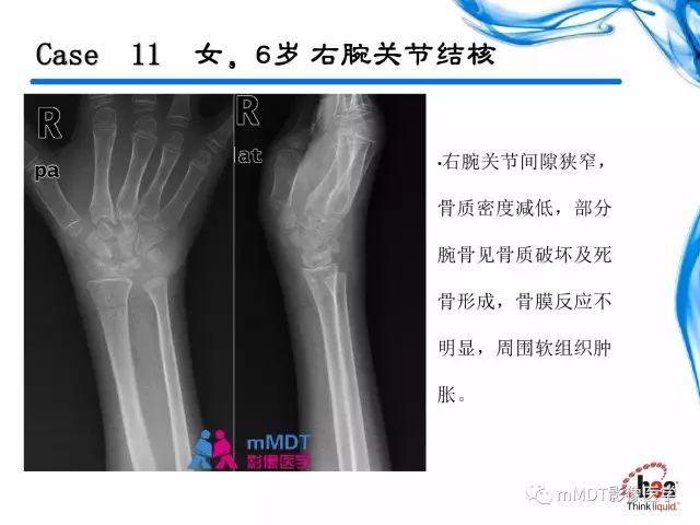 【PPT】四肢关节结核影像诊断与鉴别