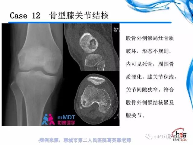 【PPT】四肢关节结核影像诊断与鉴别