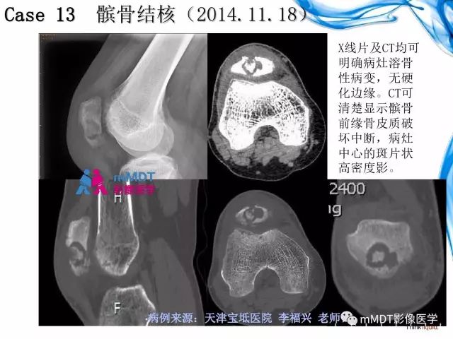 【PPT】四肢关节结核影像诊断与鉴别
