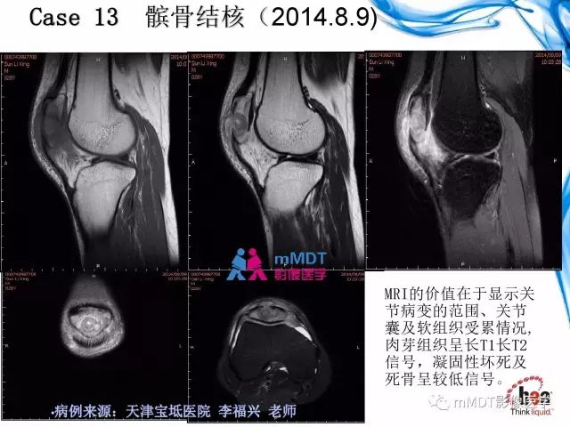 【PPT】四肢关节结核影像诊断与鉴别