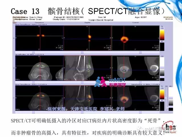 【PPT】四肢关节结核影像诊断与鉴别