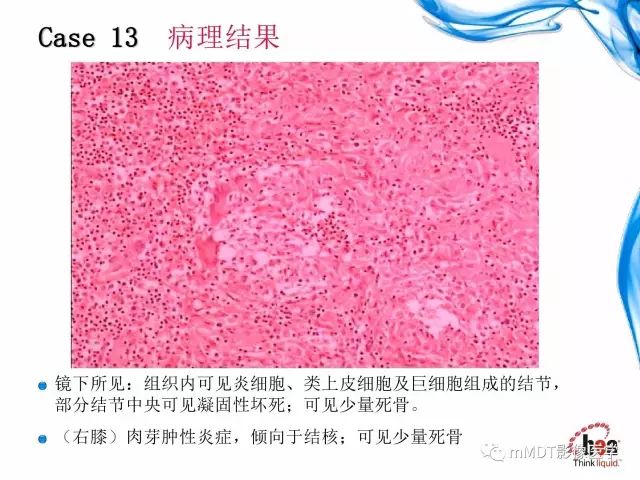 【PPT】四肢关节结核影像诊断与鉴别