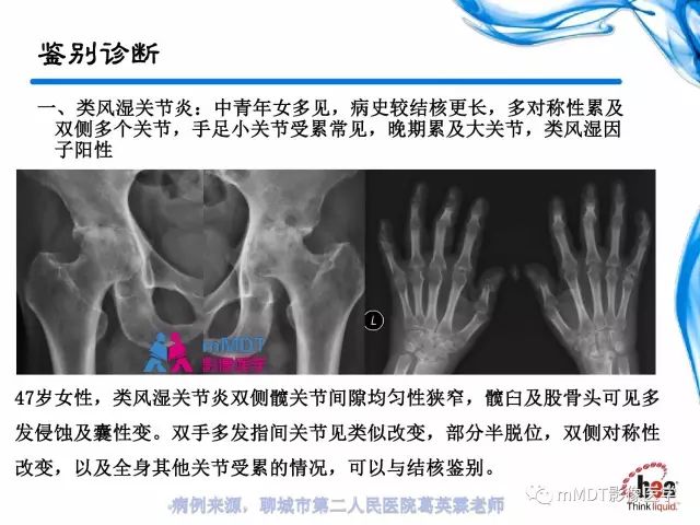 【PPT】四肢关节结核影像诊断与鉴别