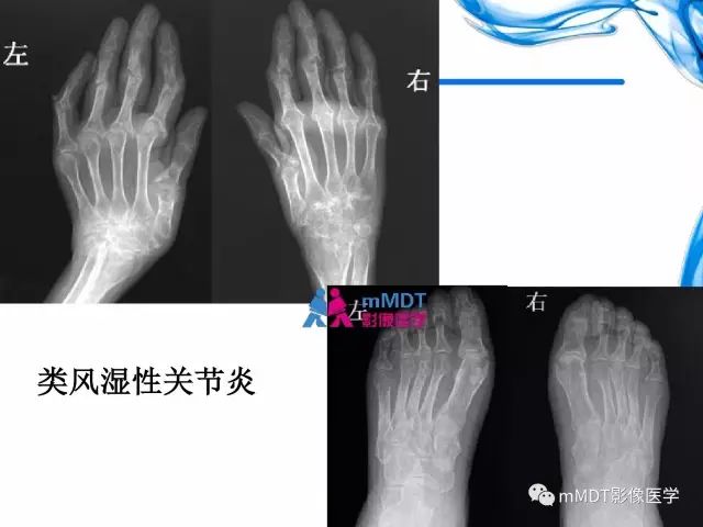 【PPT】四肢关节结核影像诊断与鉴别