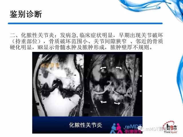 【PPT】四肢关节结核影像诊断与鉴别