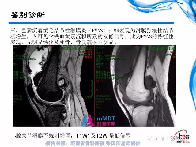【PPT】四肢关节结核影像诊断与鉴别