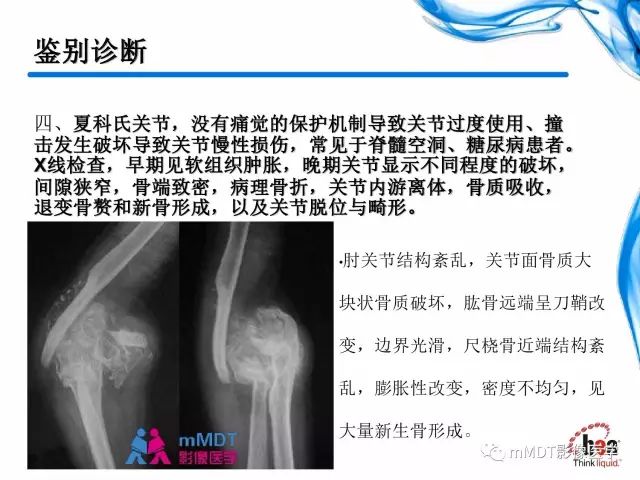 【PPT】四肢关节结核影像诊断与鉴别