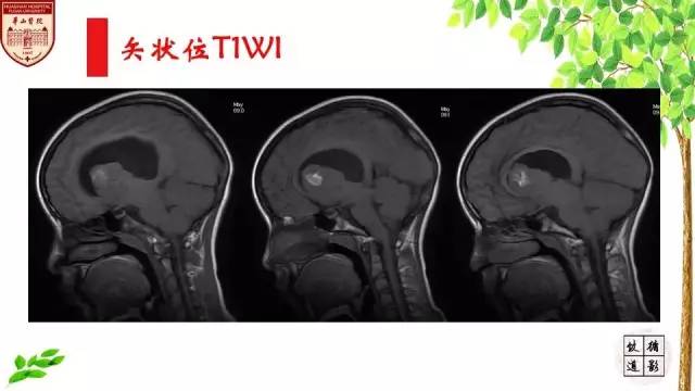 【病例】室管膜瘤1例MR影像分析
