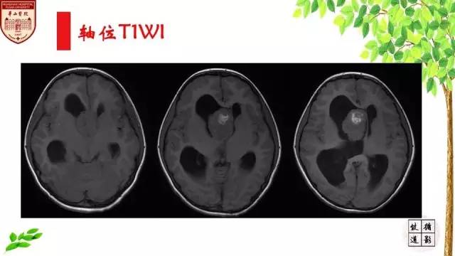 【病例】室管膜瘤1例MR影像分析