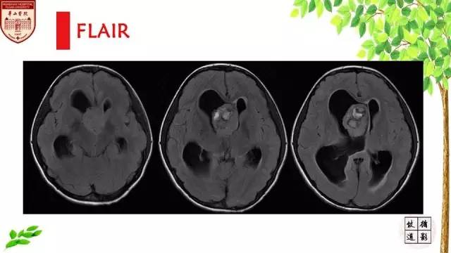 【病例】室管膜瘤1例MR影像分析