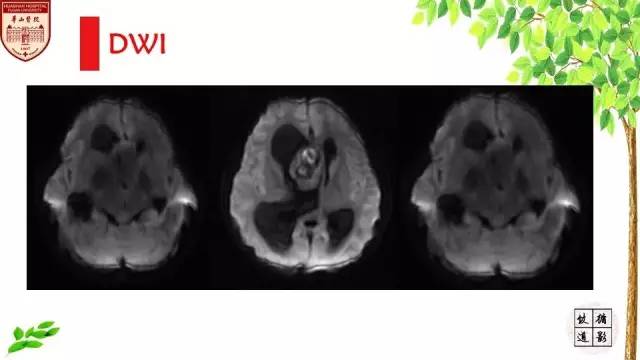 【病例】室管膜瘤1例MR影像分析