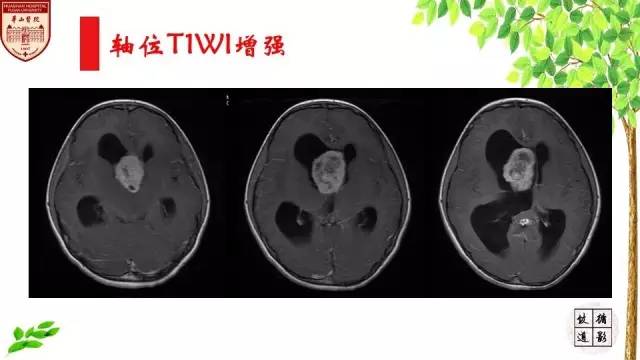 【病例】室管膜瘤1例MR影像分析