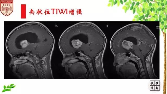【病例】室管膜瘤1例MR影像分析
