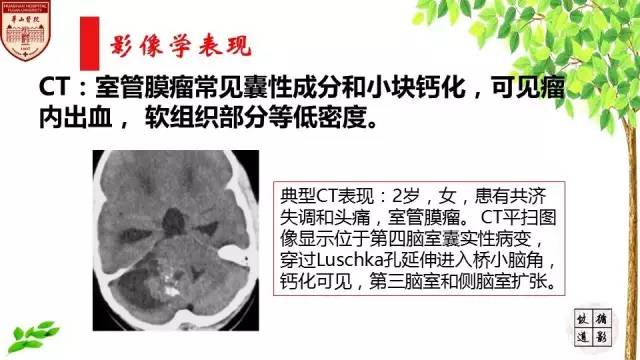 【病例】室管膜瘤1例MR影像分析