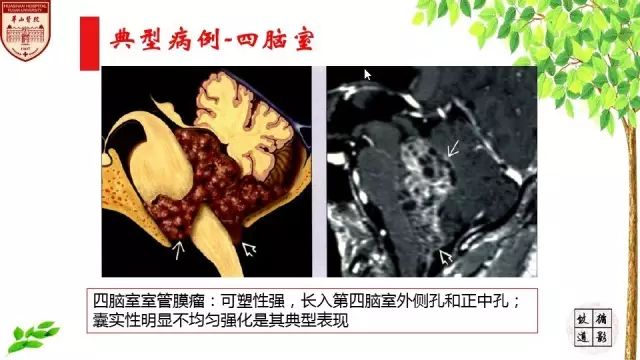 【病例】室管膜瘤1例MR影像分析