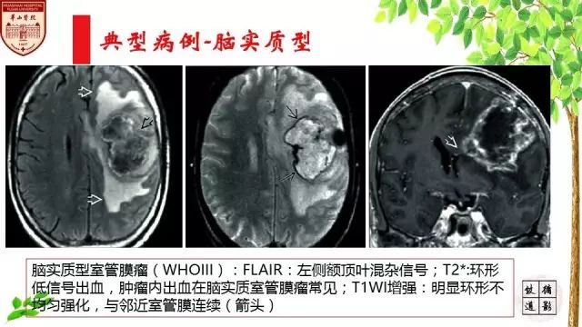 【病例】室管膜瘤1例MR影像分析