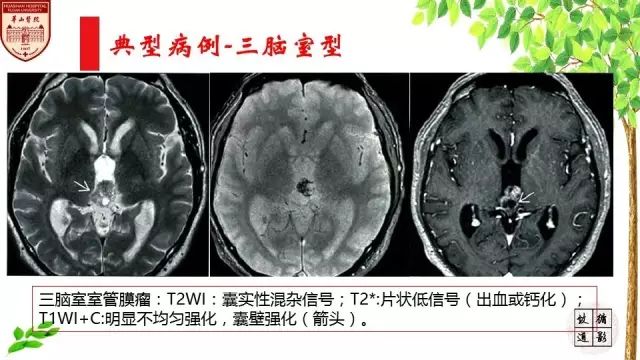 【病例】室管膜瘤1例MR影像分析