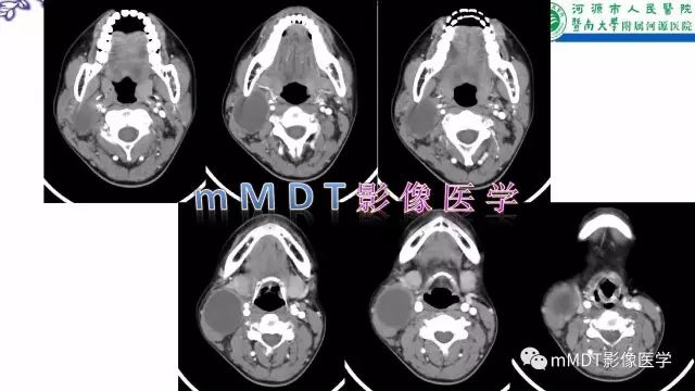 【PPT】鳃裂囊肿影像表现