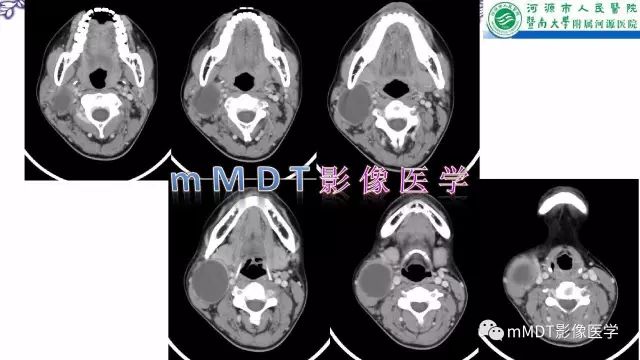 【PPT】鳃裂囊肿影像表现