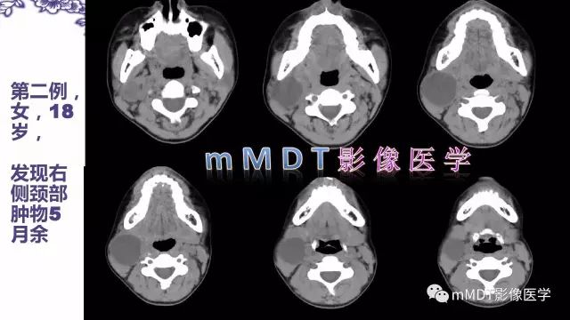 【PPT】鳃裂囊肿影像表现