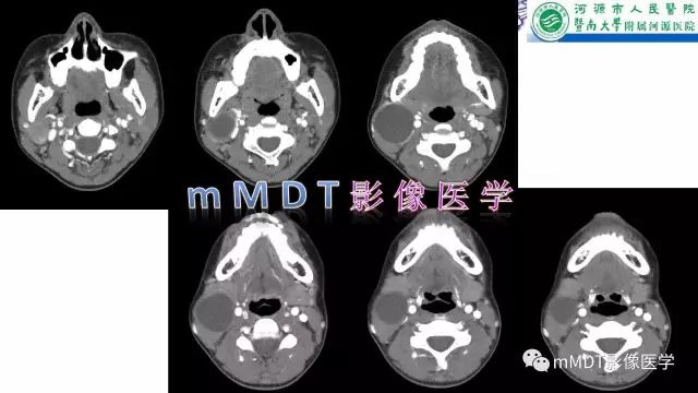 【PPT】鳃裂囊肿影像表现