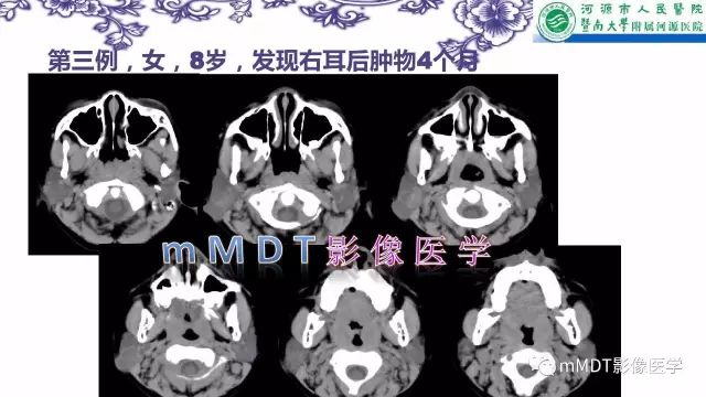 【PPT】鳃裂囊肿影像表现